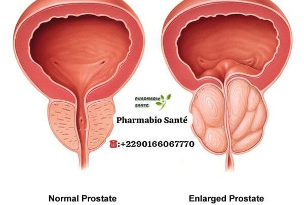 Prostate Gonflée Traitement Naturel