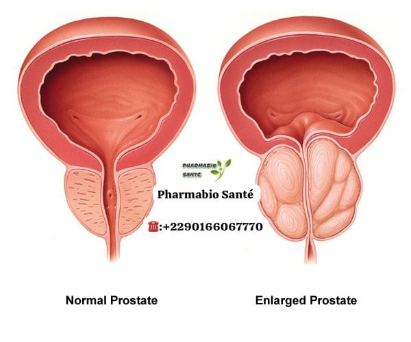 Prostate Gonflée Traitement Naturel