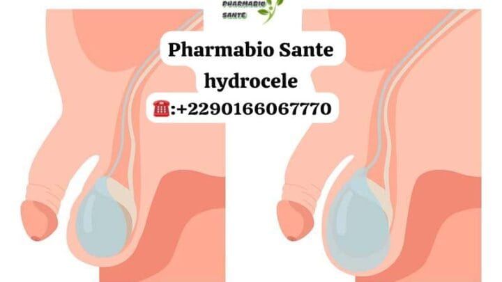 Hydrocèle Symptômes Traitements Naturels