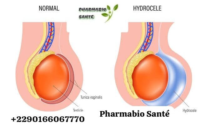 Hydrocèle Causes Traitements Naturels