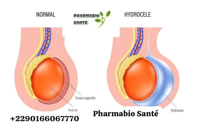 Hydrocèle Causes Traitements Naturels