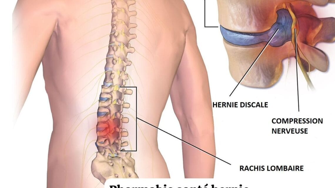 Hernie Discale Solutions Naturelles