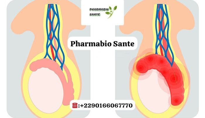 Kyste au Testicule Traitements Naturels