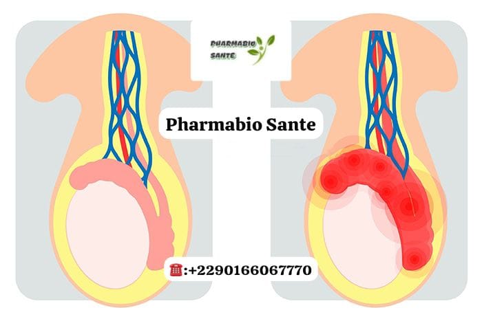 Kyste au Testicule Traitements Naturels