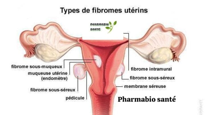 Fibrome Utérus Polymyomateux Thérapie