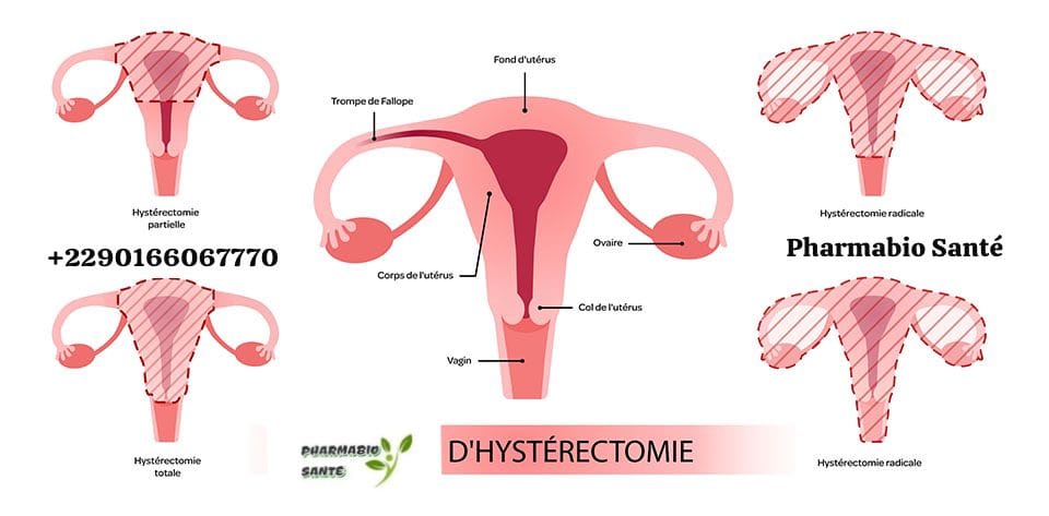 Chirurgie hystérectomie alternatives naturelles