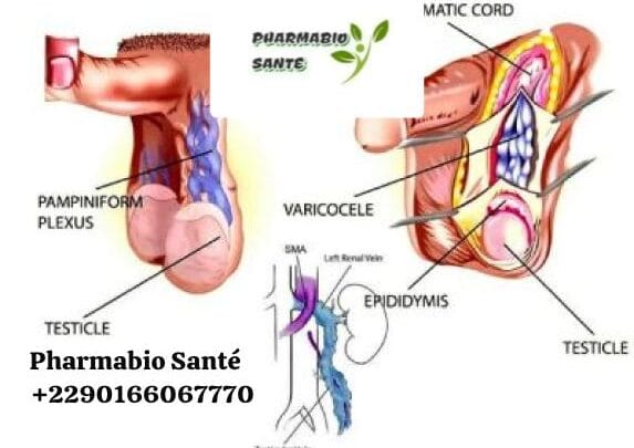 Solutions Naturelles Varicocèle Testiculaire