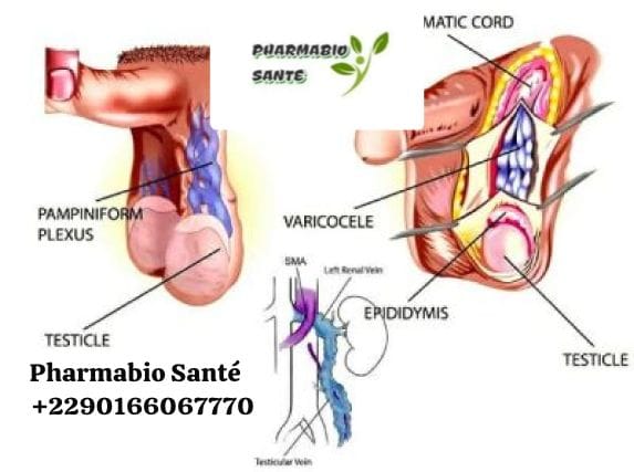 Solutions Naturelles Varicocèle Testiculaire