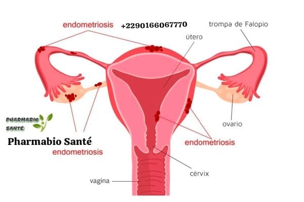 endométriose traitement naturel soulager douleurs