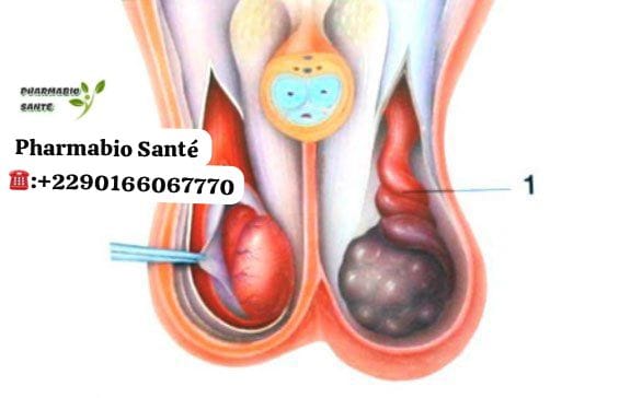 Douleur Testicule Solution Naturelle