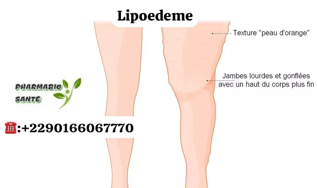 Lipoedème Remèdes Naturels