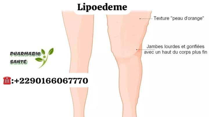 Lipoedème Remèdes Naturels