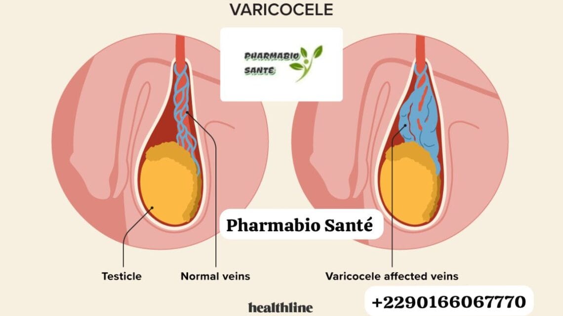 Une varicocèle peut elle disparaître