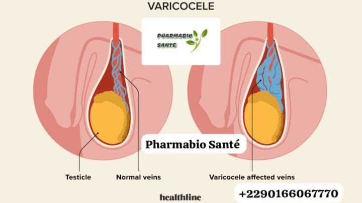 Une varicocèle peut elle disparaître