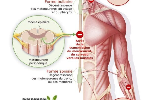 Comment arrive la maladie de Charcot