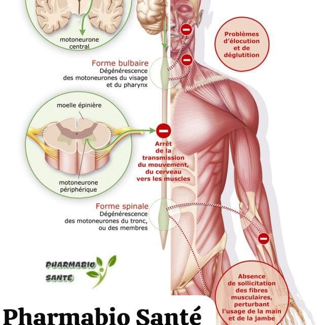 Comment arrive la maladie de Charcot
