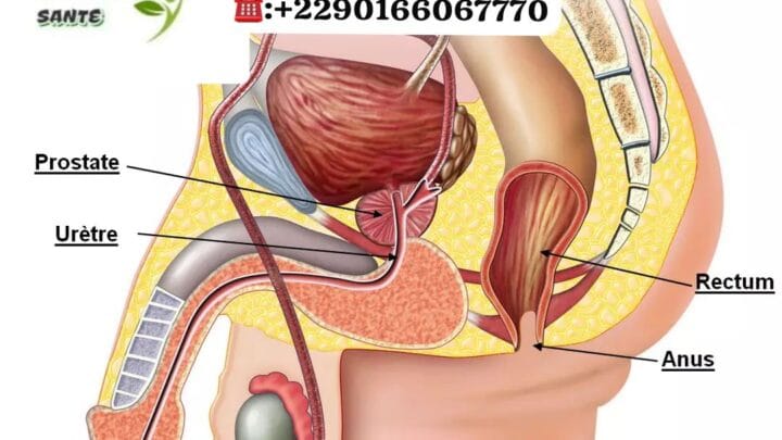 Santé Prostate Remède Naturel