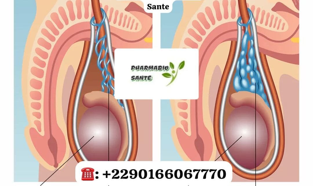 Varicocèle Solution Naturelle