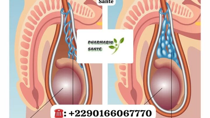 Varicocèle Solution Naturelle