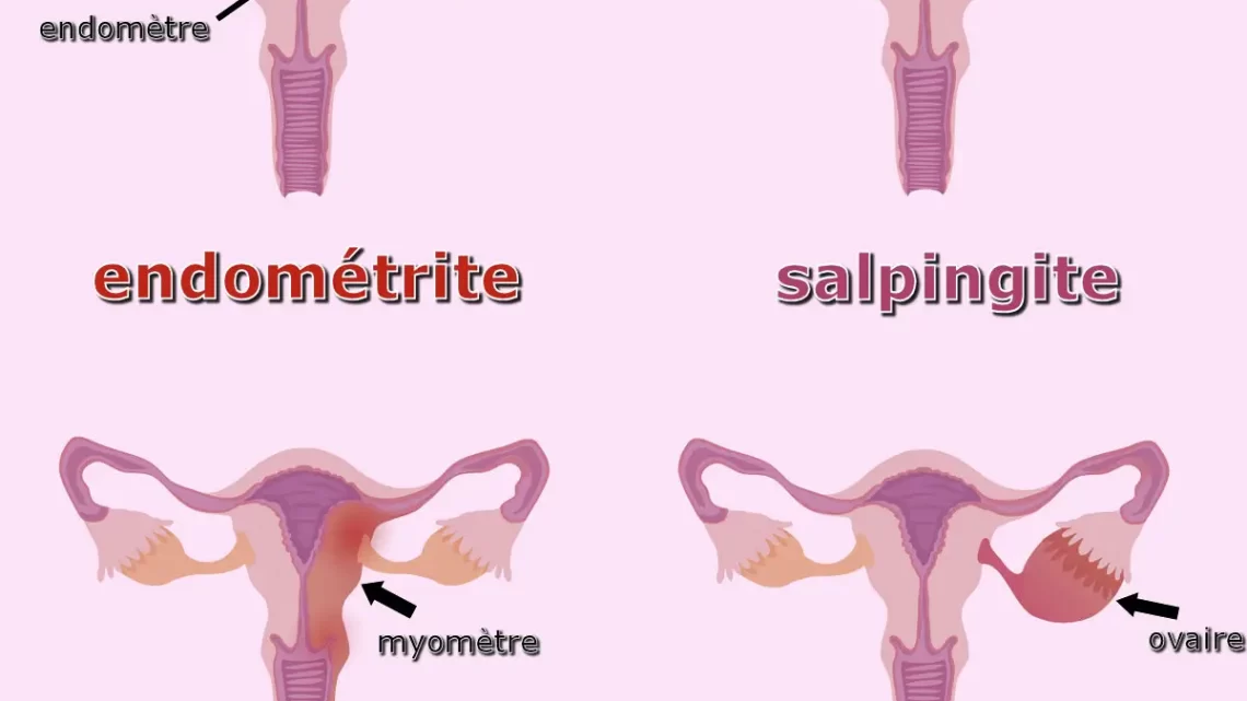Traitement Naturel pour la Salpingite