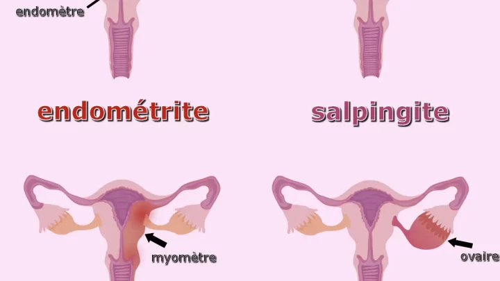 Traitement Naturel pour la Salpingite