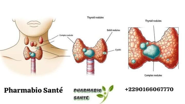 kystes thyroïdiens remèdes naturels