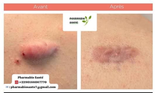 Chéloïde traitement naturel efficace