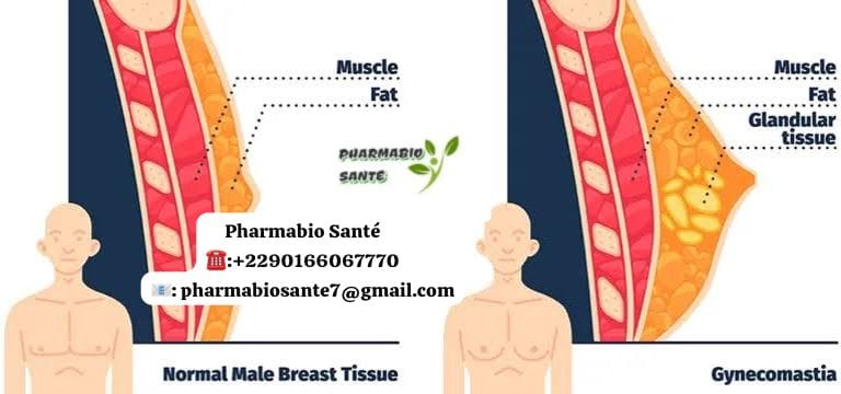 Comment Éliminer la Gynécomastie