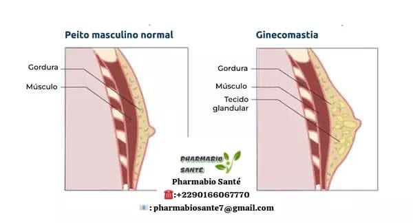Gynécomastie Causes