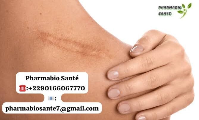 Enlever une chéloïde naturellement