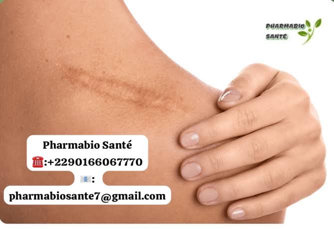 Enlever une chéloïde naturellement