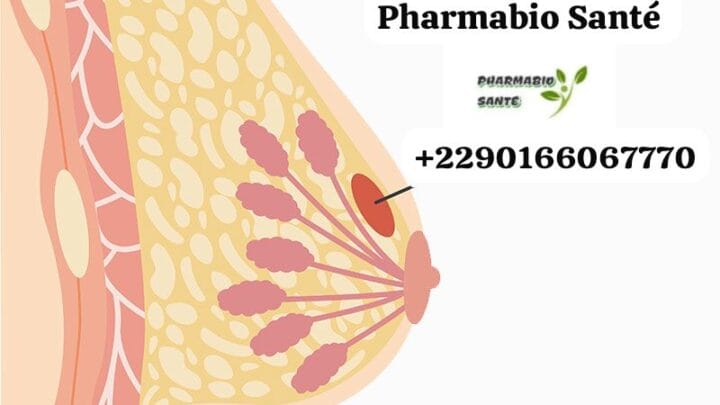 Kystes mammaires traitements naturels