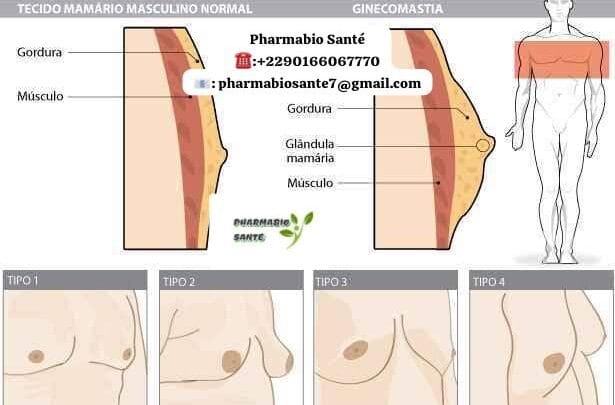 Savoir si on a une Gynécomastie