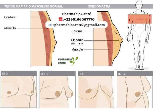 Savoir si on a une Gynécomastie