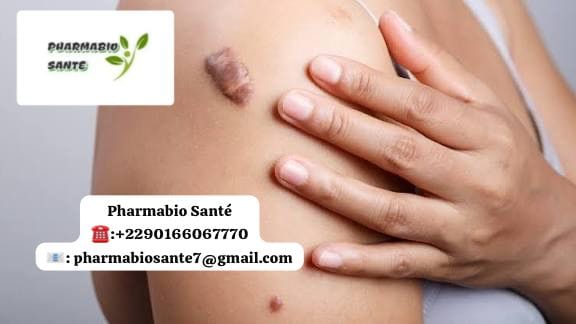 Traitement naturel chéloïde cicatrice