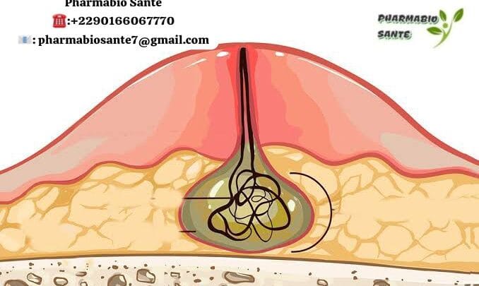 Pansements Naturels pour Abcès