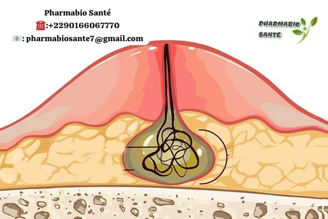 Pansements Naturels pour Abcès