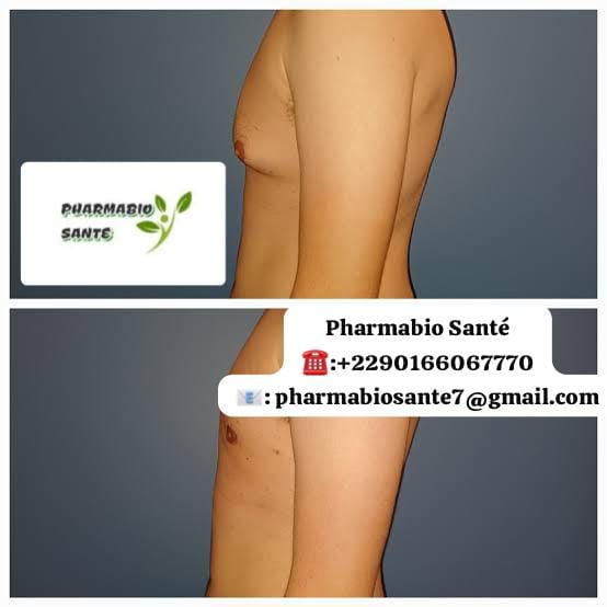 Gynécomastie et Musculation