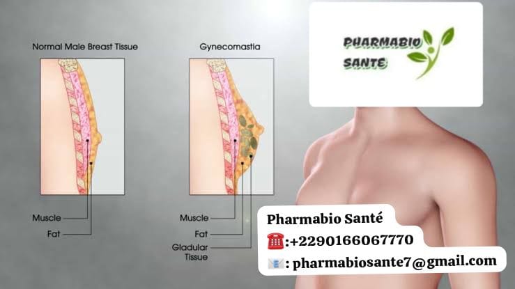 Gynécomastie Que Faire