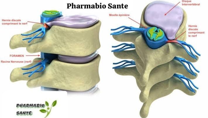 Traitements Naturels pour la Hernie Discale
