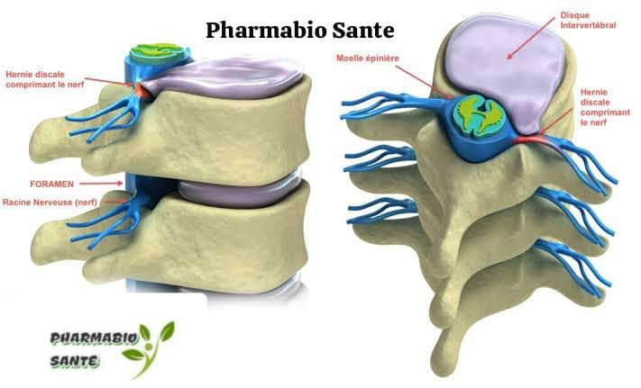 Traitements Naturels pour la Hernie Discale