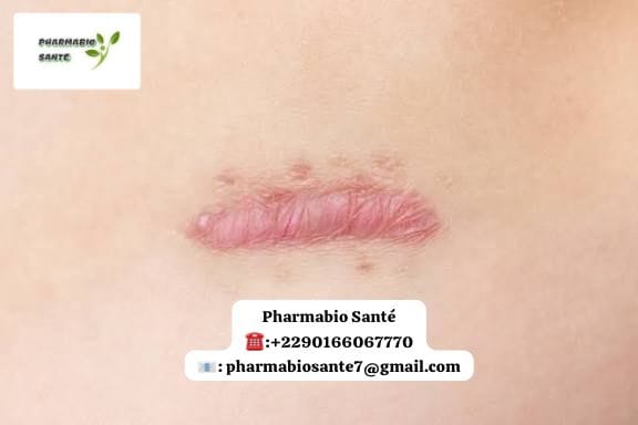 Pommade Naturelle pour Chéloïdes