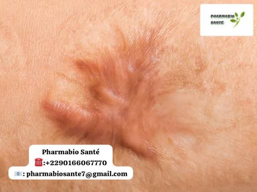 Huile essentielle chéloïde