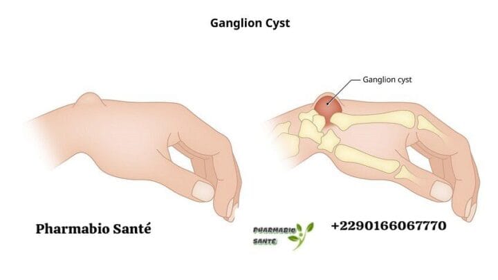 kystes ganglionnaires remèdes naturels