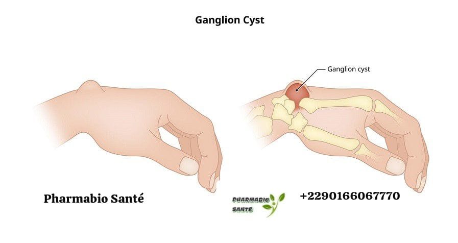 kystes ganglionnaires remèdes naturels
