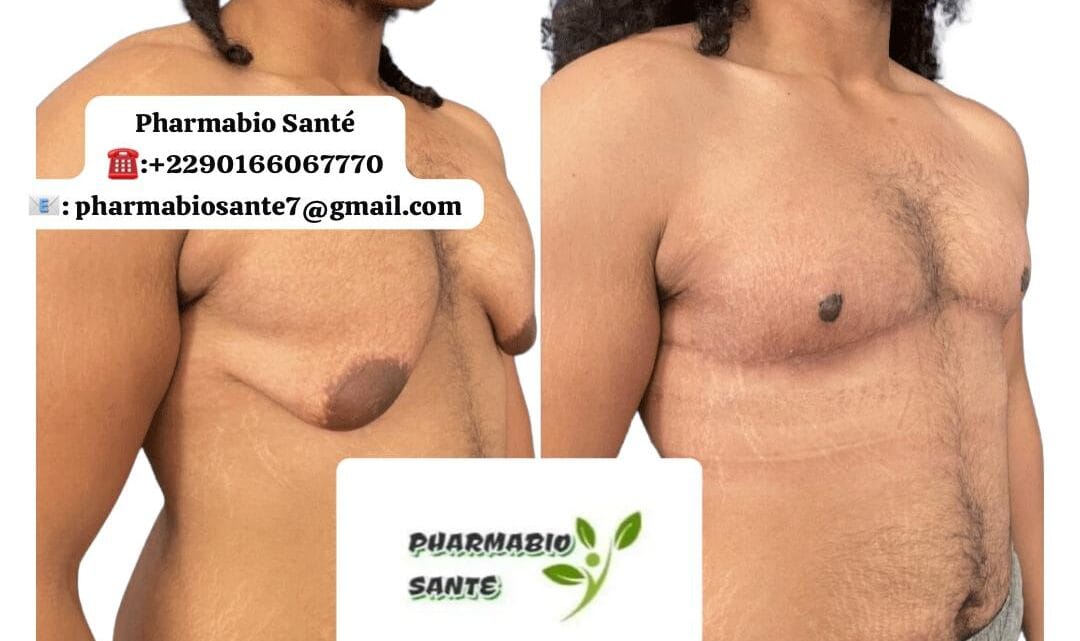 Gynécomastie et Testostérone