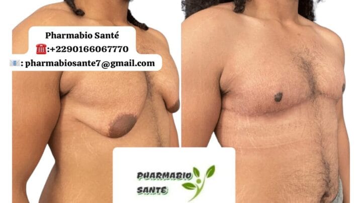 Gynécomastie et Testostérone