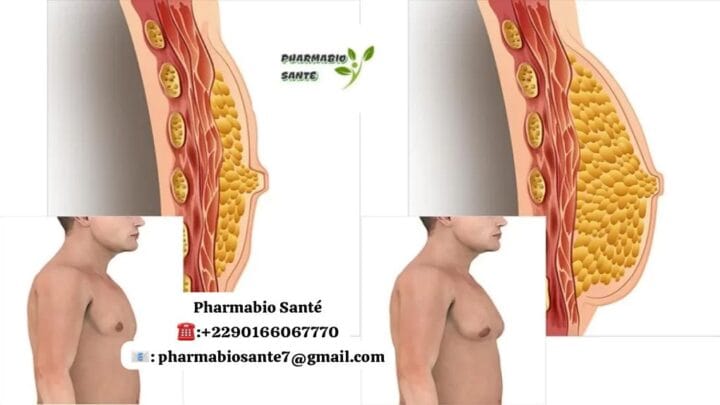 Gynécomastie Hormonale
