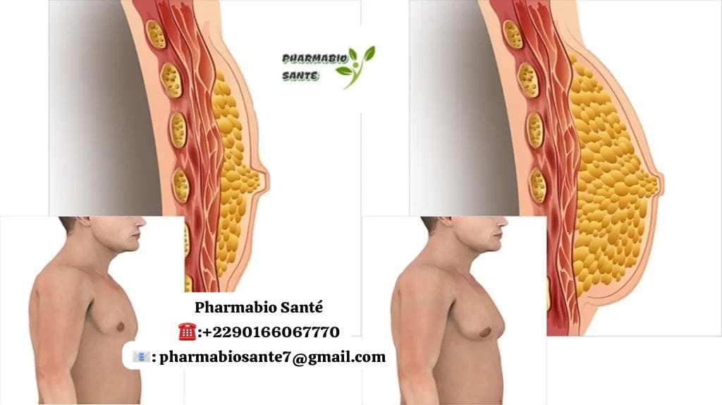 Gynécomastie Hormonale