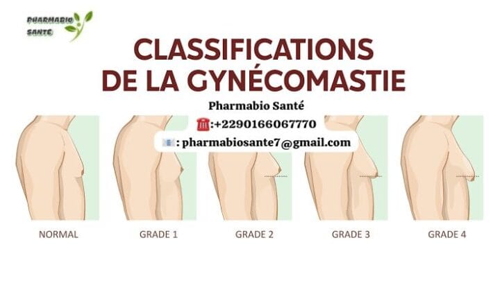 Soigner la gynécomastie naturellement